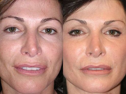 avant et après le rajeunissement de la peau au plasma