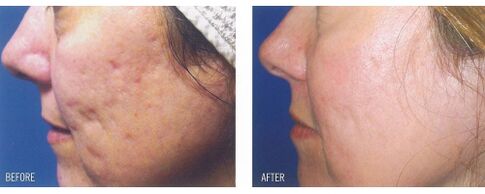 Avant et après l'application de l'appareil laser sur la peau avec des cicatrices