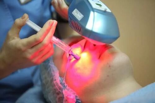 Biorevitalisation laser de la peau du visage