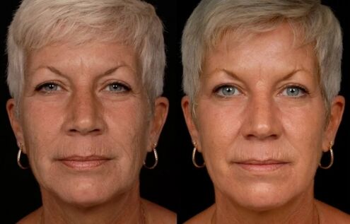 Le résultat du traitement au laser de la peau du visage - réduction des rides