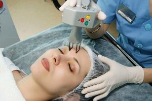 Rajeunissement fractionné de la peau du visage au laser