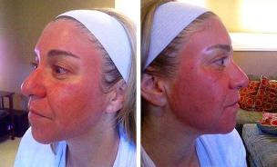 Rougeur du visage après le rajeunissement au laser