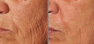 photo avant et après le rajeunissement fractionné de la peau