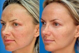 photo avant et après le rajeunissement de la peau avec l'appareil